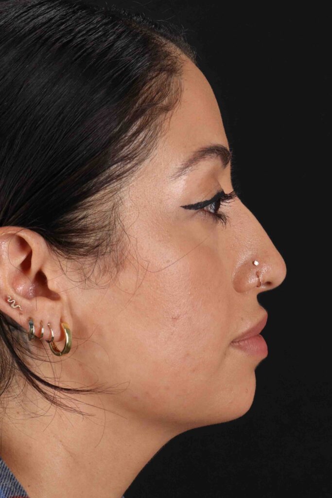 Before - right_lateral