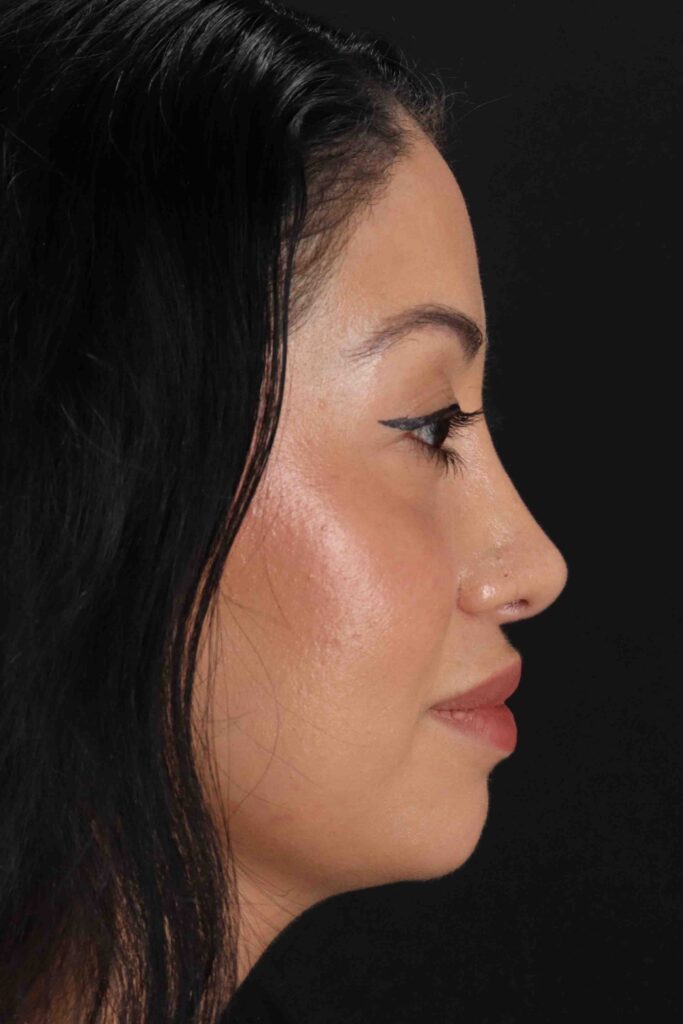 After - right_lateral