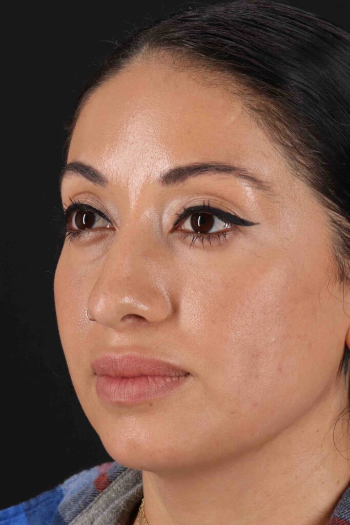 Before - left_oblique