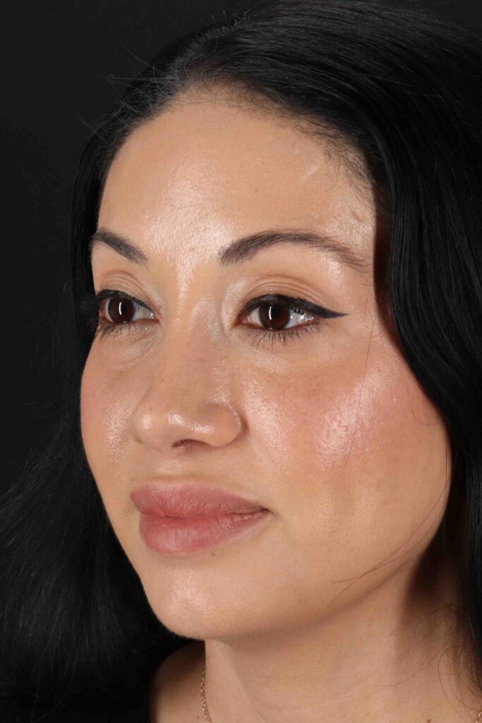 After - left_oblique