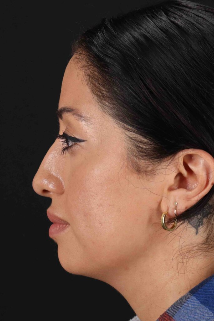 Before - left_lateral