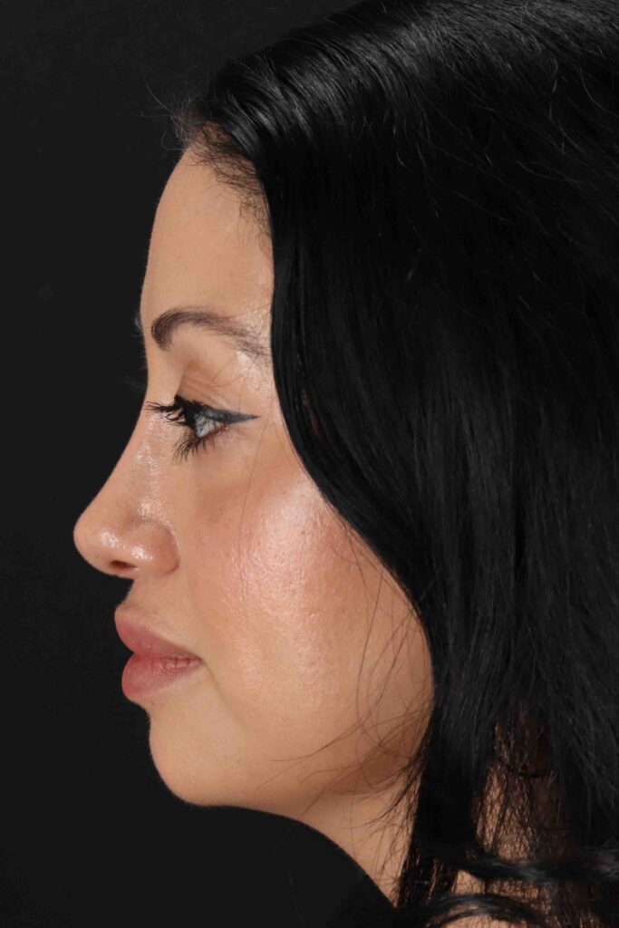 After - left_lateral