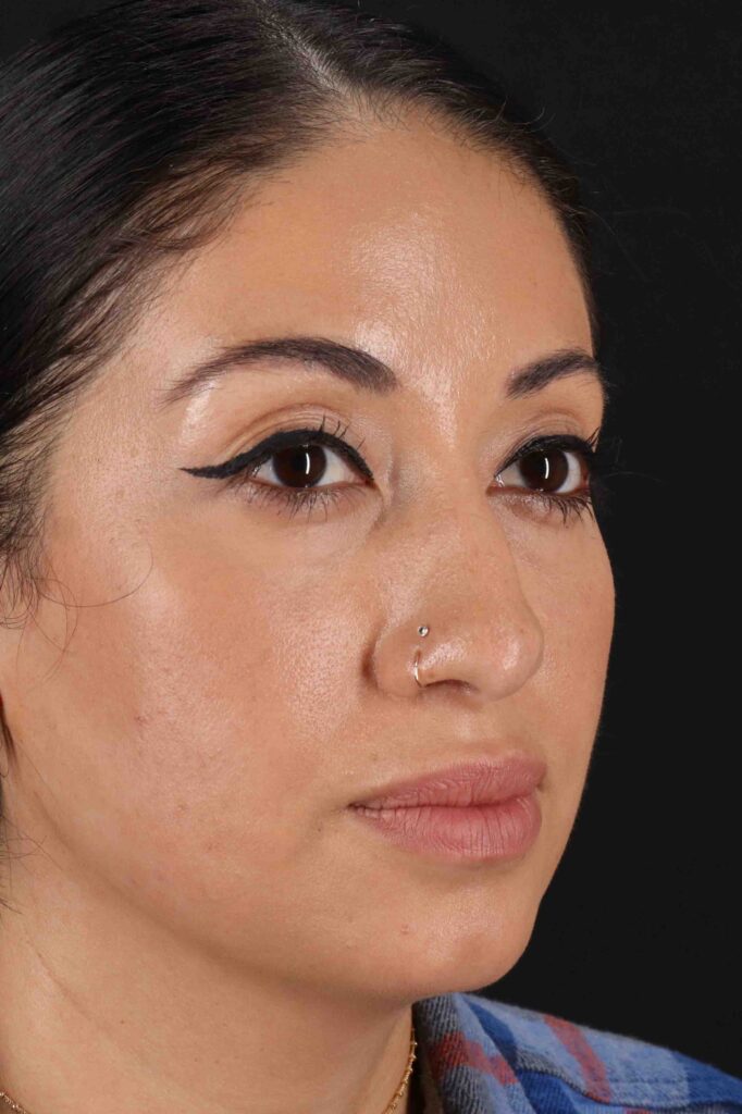 Before - right_oblique