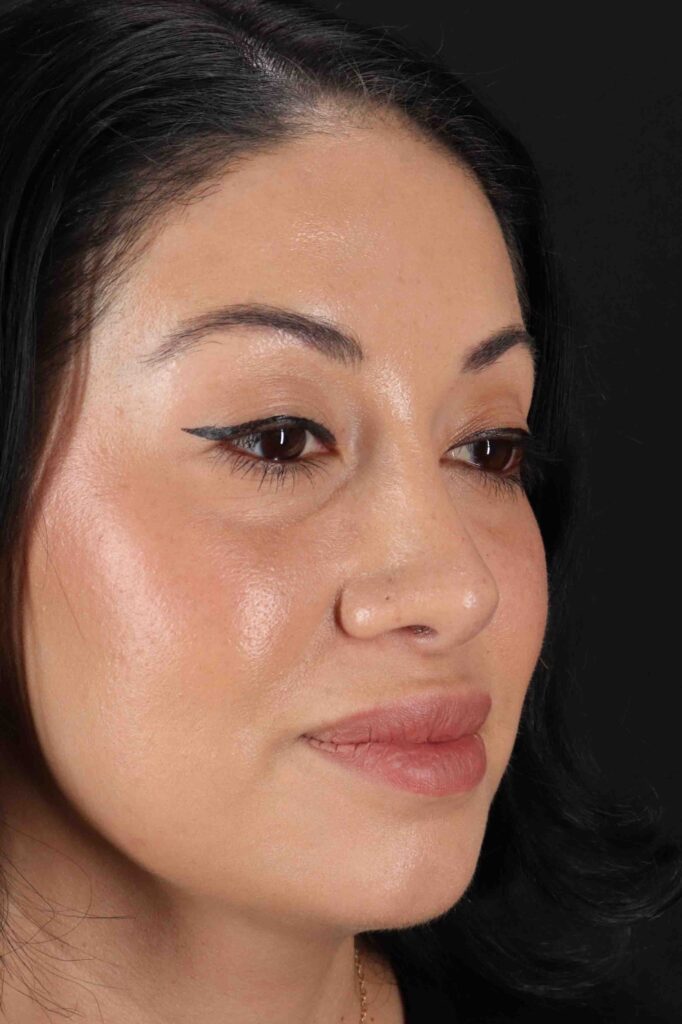 After - right_oblique