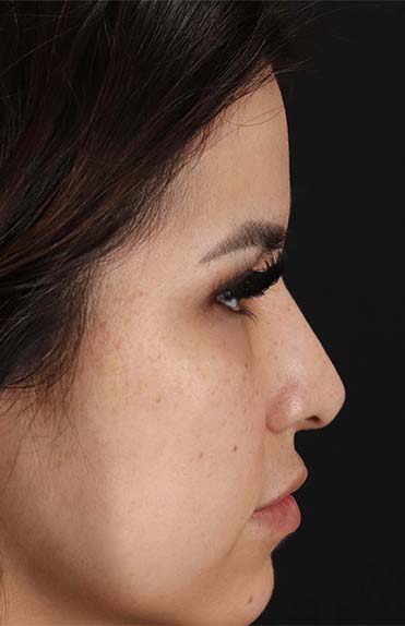 Before - right_lateral