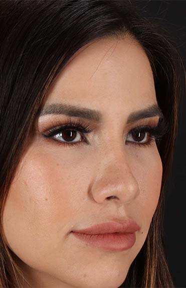 After - right_oblique