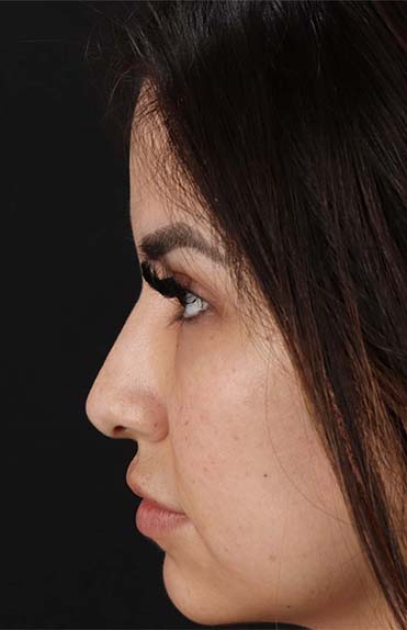 Before - left_lateral