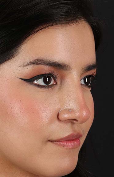 After - right_oblique