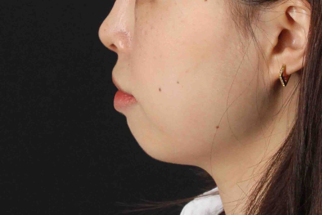 After - left_lateral