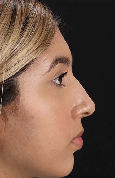 Before - right_lateral