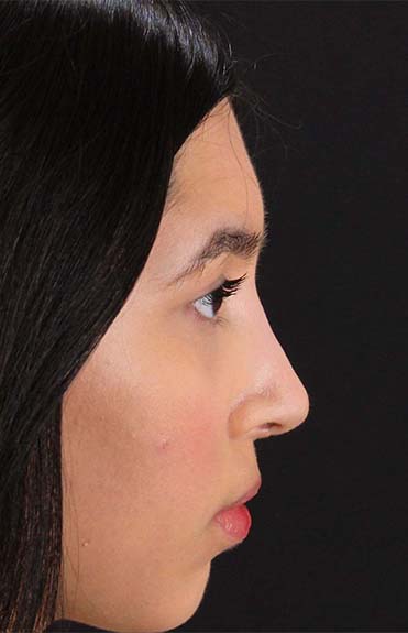 After - right_lateral