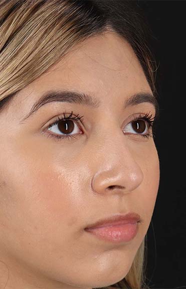 Before - right_oblique