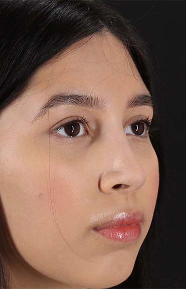 After - right_oblique