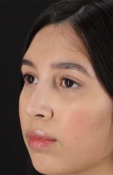 After - left_oblique