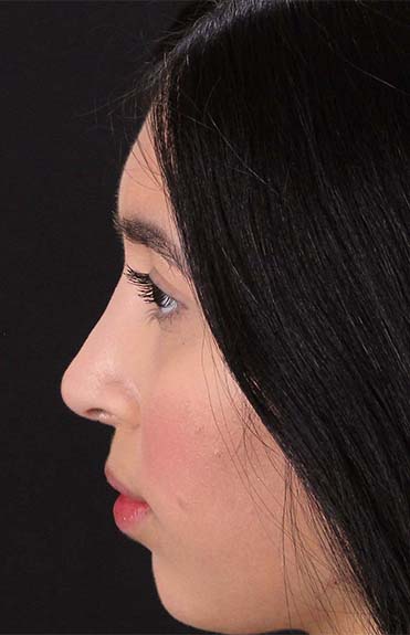 After - left_lateral