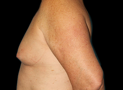 Before - left_lateral