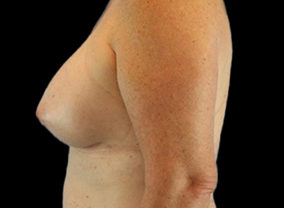 After - left_lateral