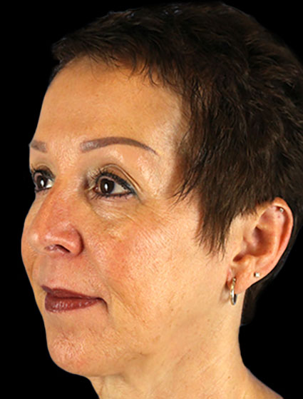 Before - left_oblique