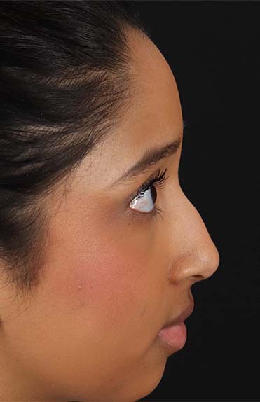 Before - right_lateral