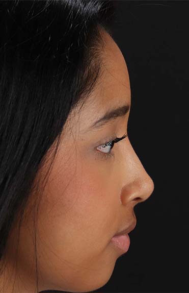 After - right_lateral