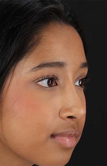 After - right_oblique