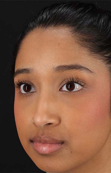 Before - left_oblique