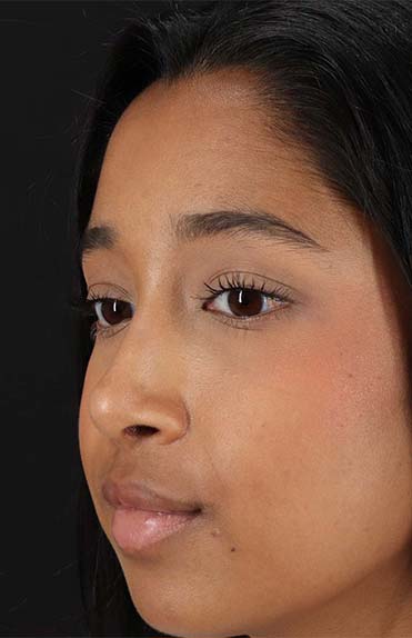 After - left_oblique