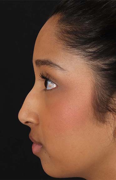 Before - left_lateral