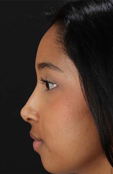 After - left_lateral