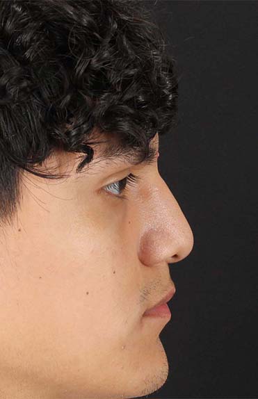 Before - right_lateral