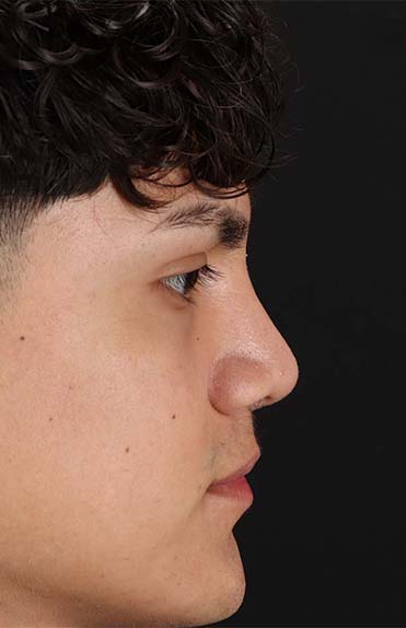 After - right_lateral