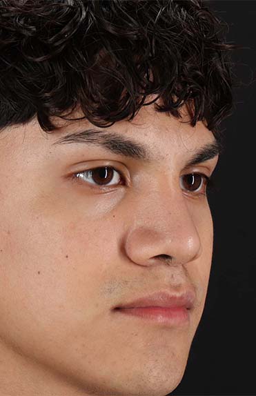 After - right_oblique