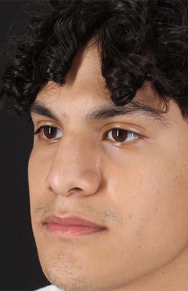 Before - left_oblique