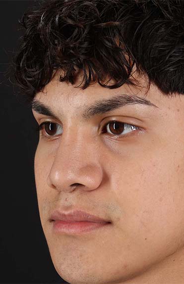 After - left_oblique