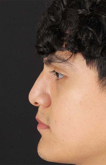 Before - left_lateral