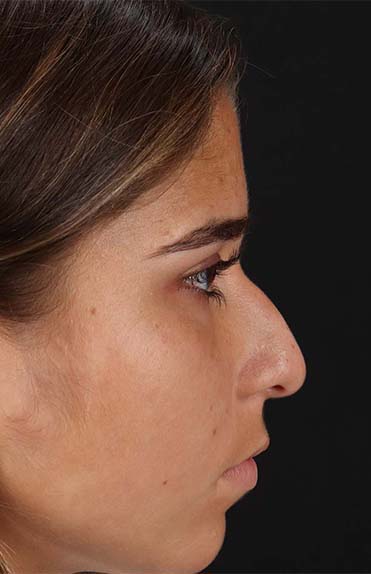 Before - right_lateral