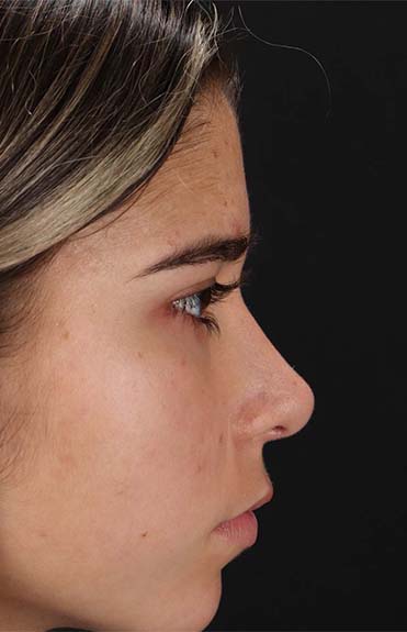 After - right_lateral