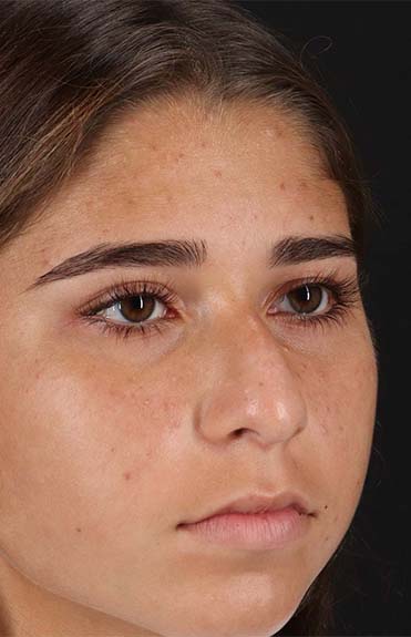 Before - right_oblique