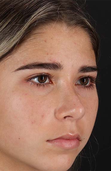 After - right_oblique