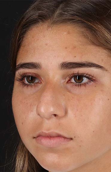 Before - left_oblique