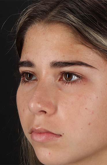 After - left_oblique