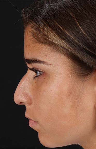 Before - left_lateral