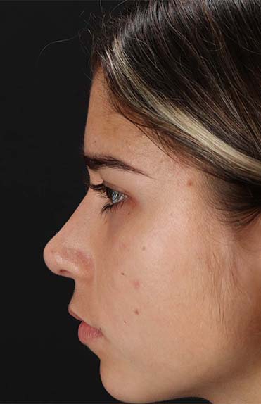 After - left_lateral