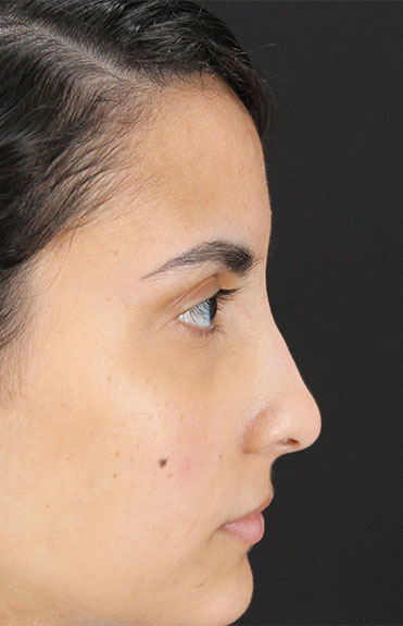 Before - right_lateral