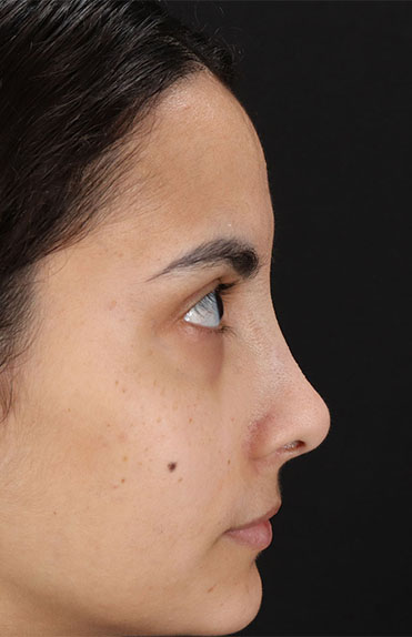 After - right_lateral