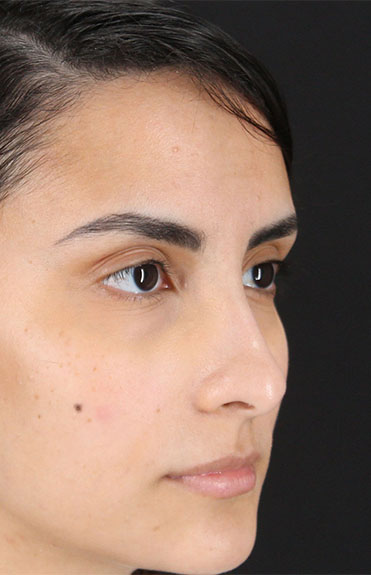 Before - right_oblique