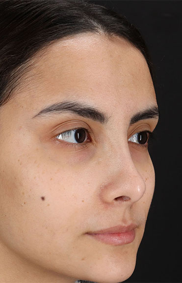 After - right_oblique