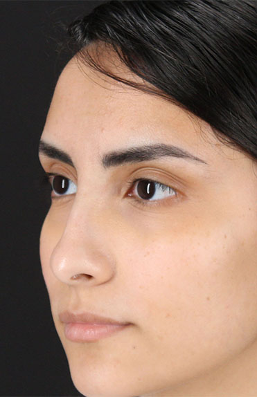 Before - left_oblique