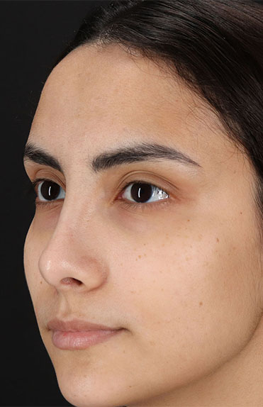 After - left_oblique