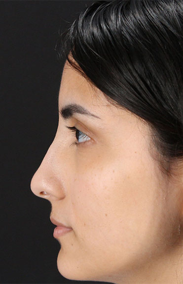 Before - left_lateral